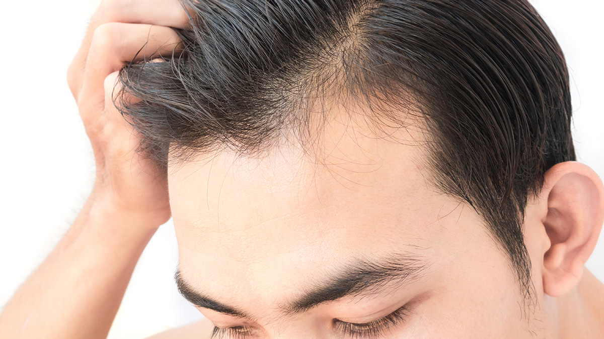 Τριχόπτωση: Η βιταμίνη που δυναμώνει τα μαλλιά – Οι τροφές που την περιέχουν