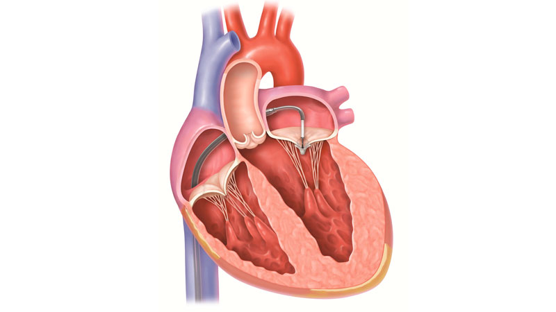 MitraClip στο Metropolitan: Επιδιόρθωση βαλβίδας της καρδιάς χωρίς διάνοιξη του θώρακα