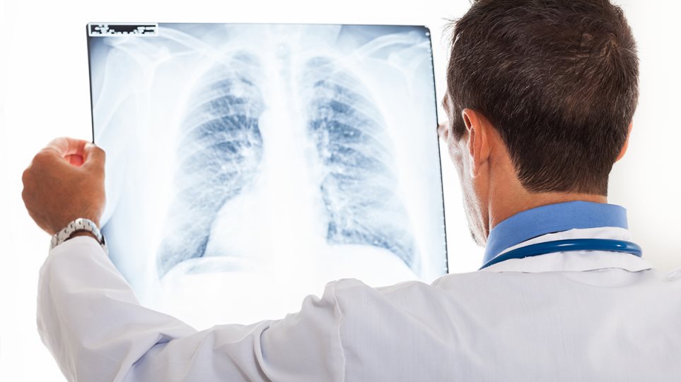 Καρκίνος πνεύμονα: Θεραπεία παρατείνει το προσδόκιμο επιβίωσης