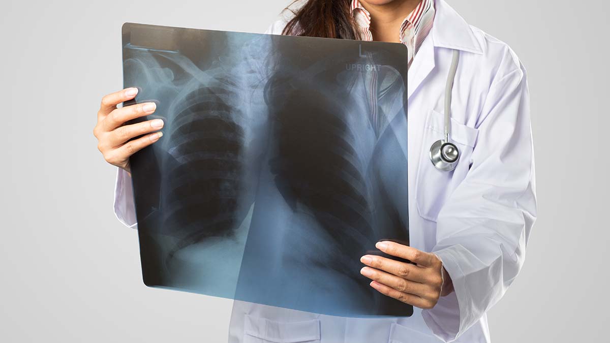 Καρκίνος Πνεύμονα: Ο απρόσμενος παράγοντας που αυξάνει τον κίνδυνο