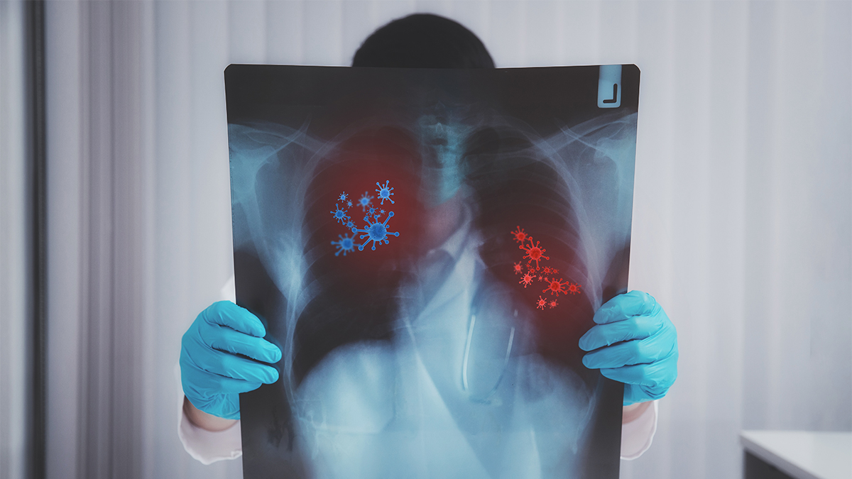 Κορωνοϊός: Ο σοβαρός κίνδυνος για τους πνεύμονες που διπλασιάστηκε μετά τη λοίμωξη