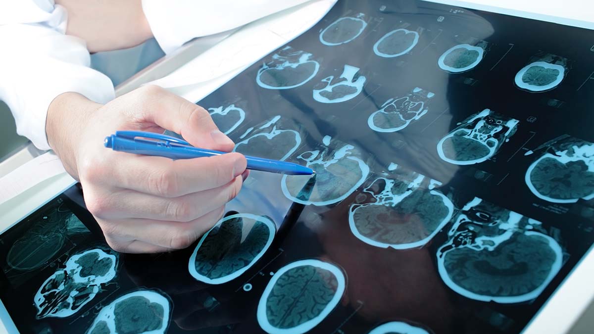 Μνήμη: Εξέταση υπολογίζει την ηλικία του εγκεφάλου – Το όφελος για την υγεία σας