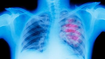 Καρκίνος του πνεύμονα: Σημαντικές καθυστερήσεις στη διάγνωση της ασθένειας και έλλειψη πληροφόρησης για θεραπείες